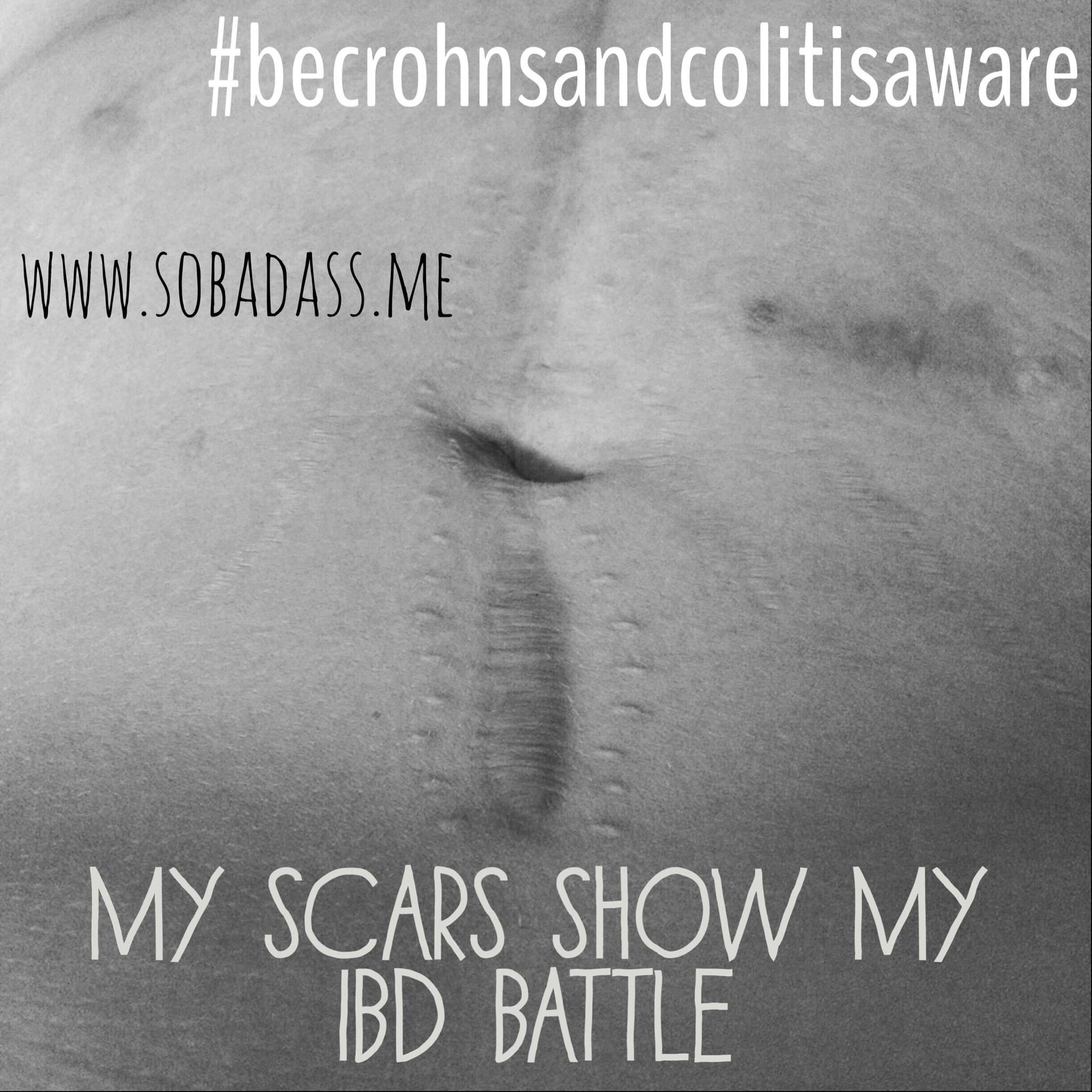 scars from a ileostomy jpouch surgery